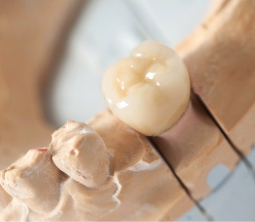 Dental crown on top of tooth in model of the mouth