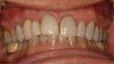 Close up of imperfect teeth before dental treatment