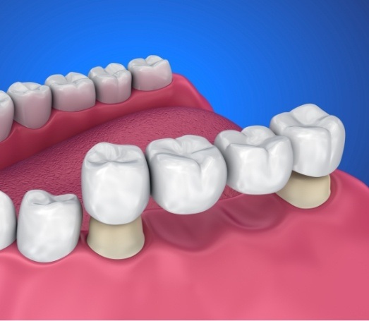 Animated dental bridge being fitted to replace two missing teeth