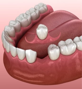 Animated partial denture being placed in the gap between two teeth
