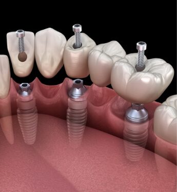 Animated dental bridge being fitted over three dental implants