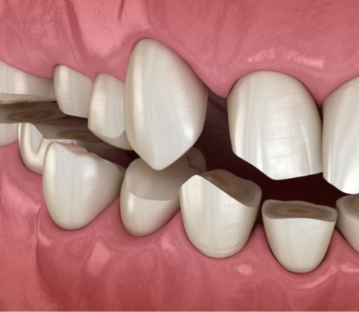 Close up of animated overcrowded and crooked teeth