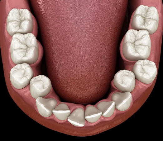 Illustration of crooked teeth