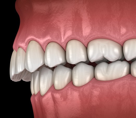 Illustration of an overbite