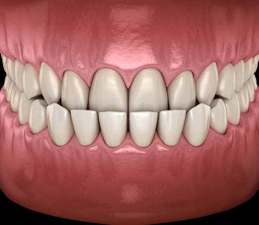 Illustration of an underbite