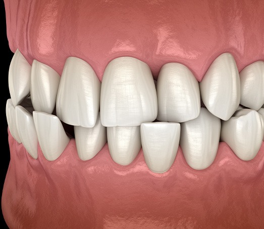 Illustration of a crossbite