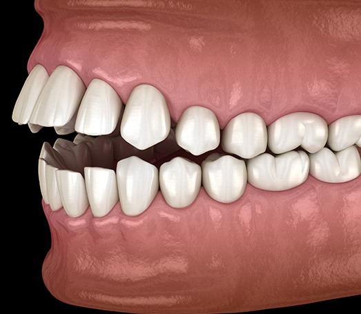 Illustration of an open bite