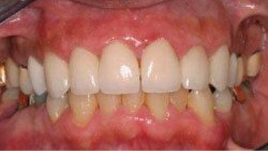 Close up of flawless smile after treatment from Los Angeles dentist