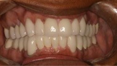 Close up of flawless smile after dental treatment