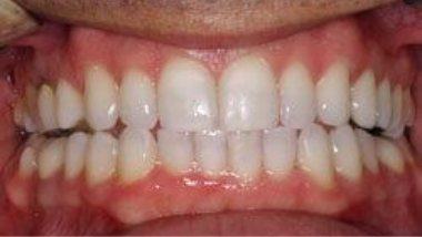 Close up of flawless smile after dental treatment