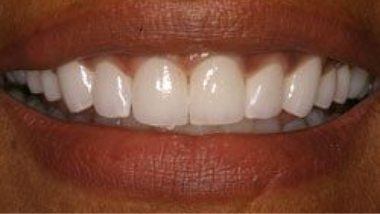 Close up of flawless smile after dental treatment