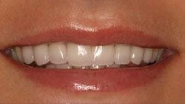 Close up of flawless smile after dental treatment