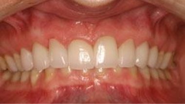 Close up of flawless smile after dental treatment