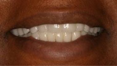 Close up of flawless smile after dental treatment