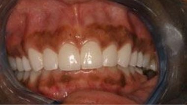 Close up of flawless smile after dental treatment