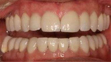 Close up of flawless smile after dental treatment