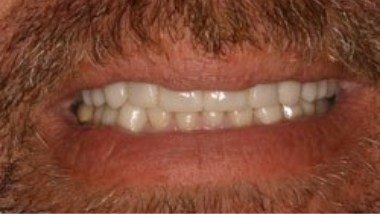 Close up of flawless smile after dental treatment