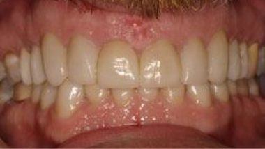 Close up of flawless smile after dental treatment