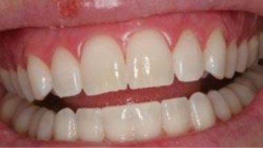 Close up of flawless smile after dental treatment