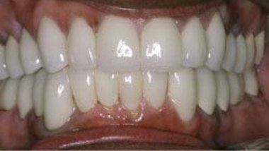 Close up of flawless smile after dental treatment