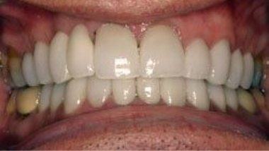 Close up of flawless smile after dental treatment