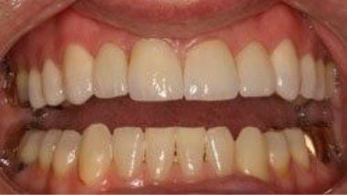 Close up of flawless smile after dental treatment