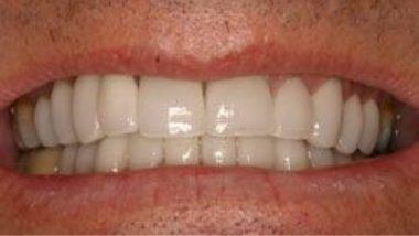 Close up of flawless smile after dental treatment