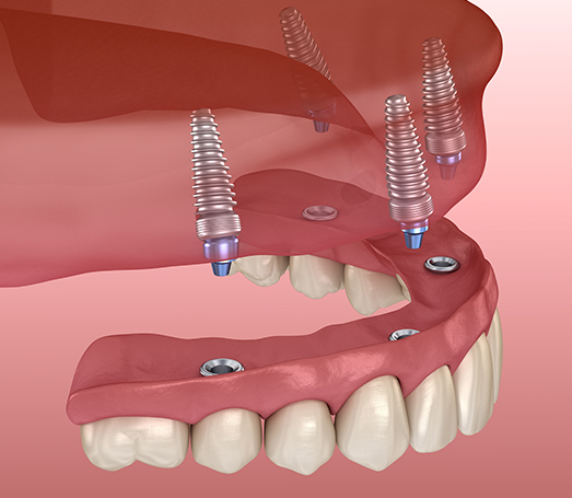 Animated All on 4 implant denture being placed on upper arch