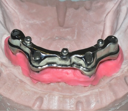 Model of All on 4 implant denture on lower arch