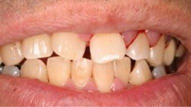 Close up of imperfect teeth before treatment from Los Angeles dentist