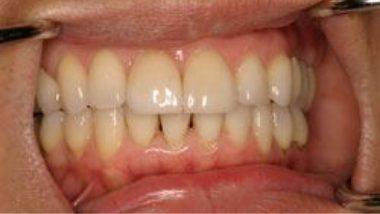 Close up of imperfect teeth before dental treatment