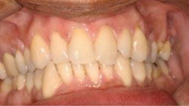 Close up of imperfect teeth before dental treatment