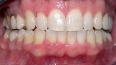 Close up of imperfect teeth before dental treatment