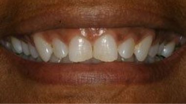 Close up of imperfect teeth before dental treatment