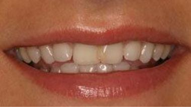 Close up of imperfect teeth before dental treatment