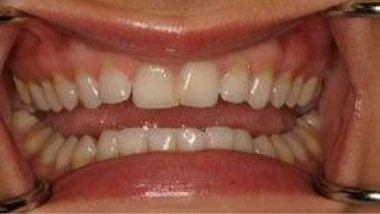 Close up of imperfect teeth before dental treatment