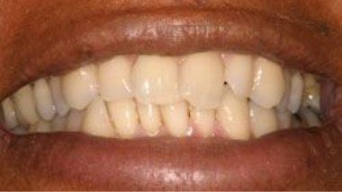 Close up of imperfect teeth before dental treatment