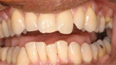 Close up of imperfect teeth before dental treatment