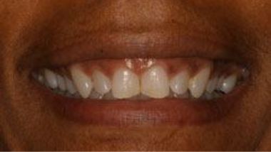 Close up of imperfect teeth before dental treatment