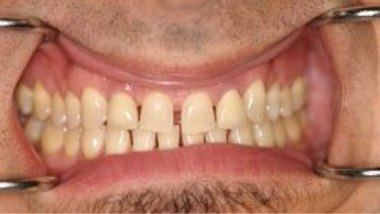 Close up of imperfect teeth before dental treatment