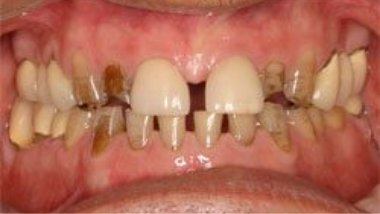 Close up of imperfect teeth before dental treatment