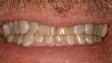 Close up of imperfect teeth before dental treatment