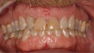 Close up of imperfect teeth before dental treatment