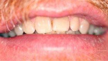 Close up of imperfect teeth before dental treatment