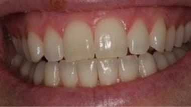 Close up of imperfect teeth before dental treatment