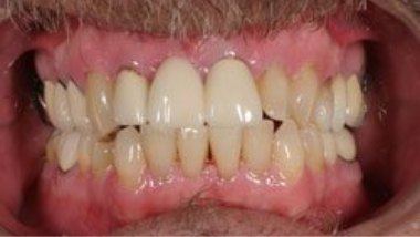 Close up of imperfect teeth before dental treatment