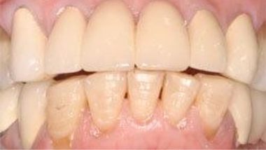 Close up of imperfect teeth before dental treatment