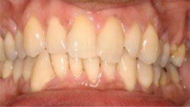 Close up of imperfect teeth before dental treatment