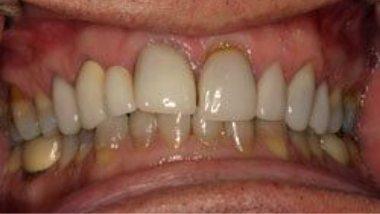 Close up of imperfect teeth before dental treatment