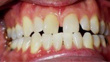 Close up of imperfect teeth before dental treatment